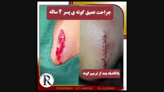 جراحی پارگی گوش