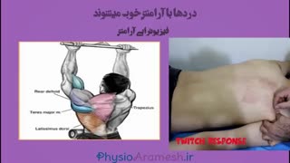 فیزیوتراپیست صادق زراعتکار، درای نیدلینگ اندام فوقانی
