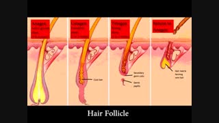 تاثیر شگفت انگیز زالو درمانی در درمان ریزش مو، تقویت ریشه مو، ریزش موی سکه ای-زالو درمانی پاسداران