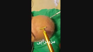 مزوتراپی - 22807060