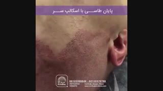 رفع طاسی سر با اسکالپ