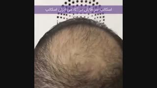 اسکالپ سر برای افرادی با موهای کم پشت