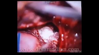 تومور اپیدرموئید CPA