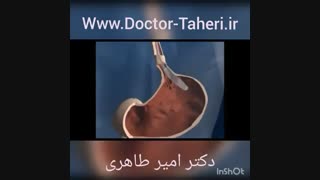 بالن گذاری داخل معده | دکتر امیر طاهری