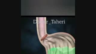 رفلاکس معده و آسیب مری | دکتر امیر طاهری