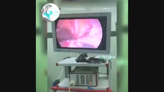 لاپاراسکوپی