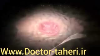 نحوه ایجاد زخم معده | دکتر امیر طاهری