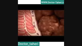 هموروئید | دکتر امیر طاهری