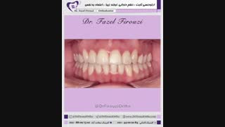 ارتودنسی ثابت | دکتر فاضل فیروزی