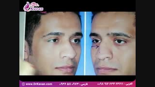 جراحی زیبایی بینی گوشتی