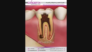 درمان ریشه دندان | کلینیک کانسپتا