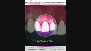 بریج (پل) دندان | کلینیک کانسپتا