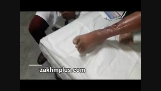 درمان زخم مزمن در کلینیک زخم پلاس
