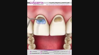 کامپوزیت دندان |کلینیک تخصصی کانسپتا