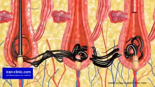 درمان فیستول با لیزر و جراحی بدون بازگشت و مراقبت های بعد از عمل جراحی