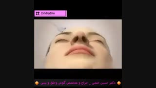 انیمیشن جراحی بینی