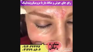 رفع جای جوش و منافذ باز با مزومیکرونیدل