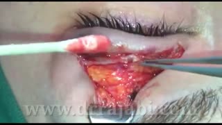 ایجاد شیار یا خط یا کریز پلکی