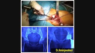 قرار دادن پروتز در استخوان ران