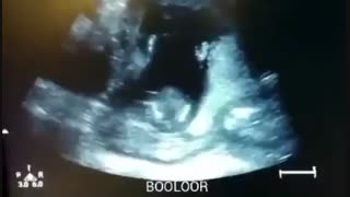 سونوگرافی  - واکنش  جنین به آواز خواندن مادر و پدر