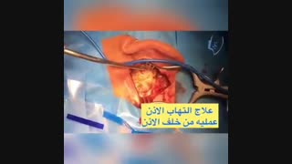 علاج التهاب الاذن بلیچینگ دندان