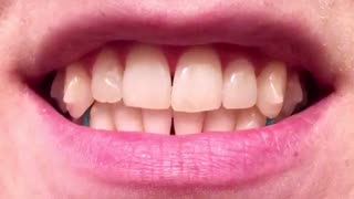 پوسیدگی دندان در ارتودنسی | دکتر قریشی