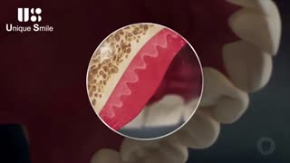 عوارض تحلیل لثه | دکتر لیلا عطایی