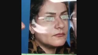 نمونه جراحی بینی با انحراف شدید