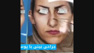 جراحی بینی با پوست ضخیم