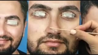 جراحی بینی گوشتی