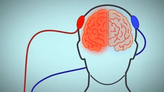 تی دی سی اس TDCS، تحریک الکتریکی مغز