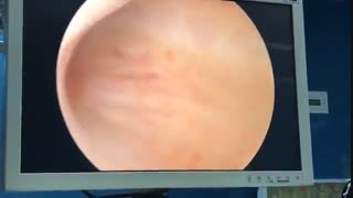 خونریزی بعد از یائسگی