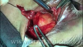 جراحی خارج کردن تومور بسیاربزرگ دمبل شکل