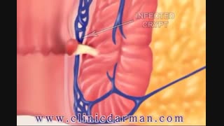 فیستول مقعدی چیست؟