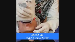 فیلم لیزر فرکشنال