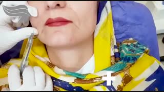 فیلم تزریق ژل خط خنده