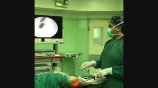 درمان پارگی مینیسک با لیزر لیزر موهای زائد