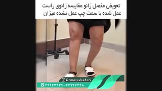 نتیجه عمل جراحی تعویض مفصل زانو | دکتر مسعود صابری متخصص ارتوپد عصب‌کشی