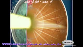انواع آب مروارید - مرکز چشم پزشکی دکتر علیرضا نادری