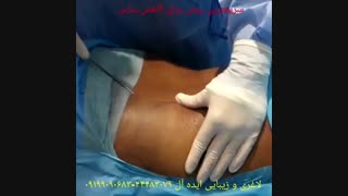 لاغری موضعی سریع با لیپوماتیک