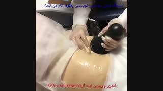 کویتیشن و لاغری موضعی عالی