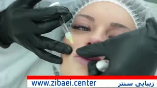 تزریق ژل به لب - برجسته کردن لب با تزریق چربی - زیبایی سنتر لیزر موهای زائد