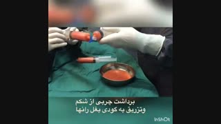 برداشت چربی از شکم و تزریق به بغل ران ها دندان پیش