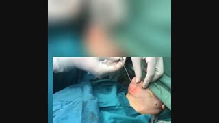 برداشت چربی غبغب و لیفت پوست گردن با لیزر بدون برش و جراحی تزریق بوتاکس