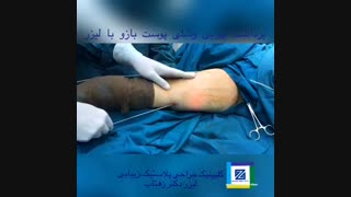 برداشت چربی و شلی پوست بازو با لیزر کلینیک پوست