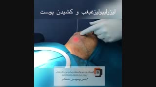 لیزر لیپولیز غبغب و کشیدن پوست کلینیک زیبایی