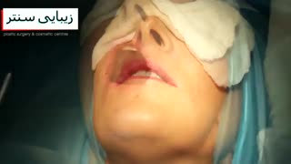 جراحی پروتز لب یا عمل برجسته کردن لب - زیبایی سنتر