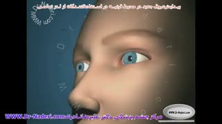 پیدایش رگهای خونی در قرنیه در مصرف کنندگان لنز -مرکز چشم پزشکی دکتر علیرضا نادری