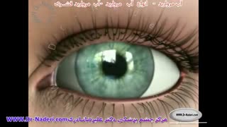 کاتاراکت کورتیکال - مرکز چشم پزشکی دکتر علیرضا نادری