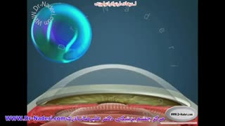 لنزهای تماسی ارتوکراتولوژی - مرکز چشم پزشکی دکتر علیرضا نادری